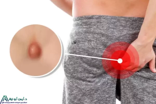 ما هو الناسور العصعصي وأسبابه وطرق علاجه -تشخيص دقيق